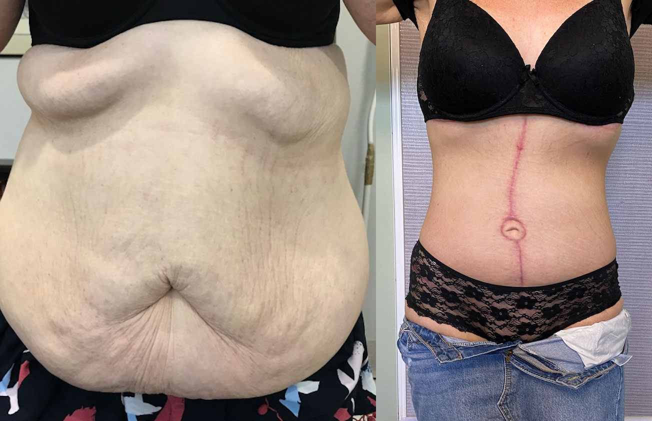 The Corset Trunkplasty: A Novel Approach to Contouring Massive Weight Loss  Patients 
