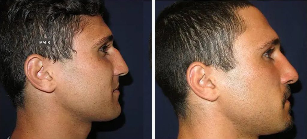Male Rhinplasty Before & After Photos By Dr Pouria Moradi Sydney