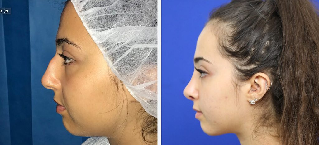 Rhinplasty Before & After Photos By Dr Pouria Moradi Sydney