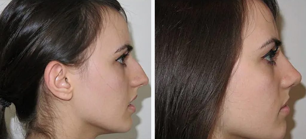 Rhinplasty Before & After Photos By Dr Pouria Moradi Sydney